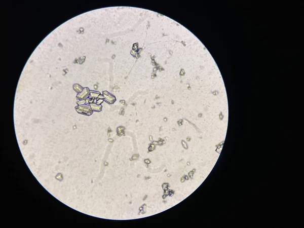 stock image Microscopic view of struvite crystals from urinary sediment. Magnesium ammonium phospate crystals. Causing Feline Lower Urinary Tract Disease 