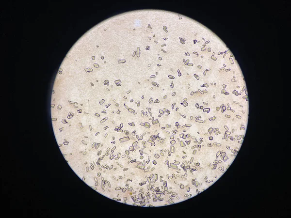 Microscopic View Struvite Crystals Urinary Sediment Magnesium Ammonium Phospate Crystals Stok Foto