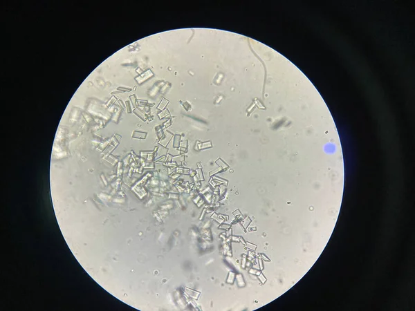 Mikroskopický Pohled Krystaly Struvitu Močového Sedimentu Krystaly Fosforečnanu Hořečnatého Způsobuje — Stock fotografie