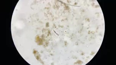 Mikroskop açısından demodeks uyuz. Parazit cilt hastalığına neden oluyor..
