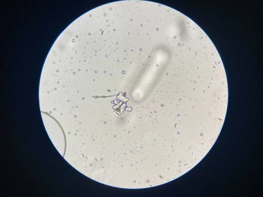 Microscopic view of struvite crystals from urinary sediment. Magnesium ammonium phospate crystals. Causing Feline Lower Urinary Tract Disease