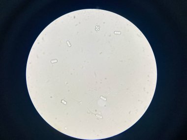 Microscopic view of struvite crystals from urinary sediment. Magnesium ammonium phospate crystals. Causing Feline Lower Urinary Tract Disease