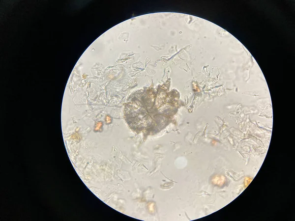 顕微鏡下のダニに注意してください 微生物 Fine Scabes とも呼ばれるNotedric Mangeは 真菌と皮膚がダニを燃焼させることによって引き起こされる感染性の高い皮膚感染症です — ストック写真