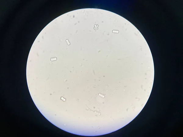 Микроскопический Вид Кристаллов Струвита Мочевых Отложений Кристаллы Фоспата Магния Причина — стоковое фото