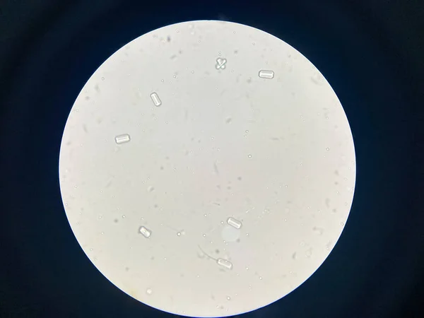 Microscopic View Struvite Crystals Urinary Sediment Magnesium Ammonium Phospate Crystals — Foto Stock
