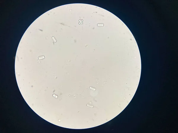 尿中堆積物からの安山岩結晶の顕微鏡像 マグネシウムアンモニウムリン酸結晶 細線性尿路疾患の原因 — ストック写真