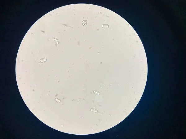 Microscopic View Struvite Crystals Urinary Sediment Magnesium Ammonium Phospate Crystals — Stock Fotó
