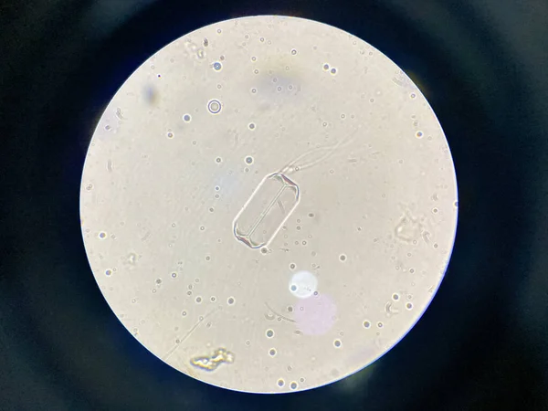 尿中堆積物からの安山岩結晶の顕微鏡像 マグネシウムアンモニウムリン酸結晶 細線性尿路疾患の原因 — ストック写真