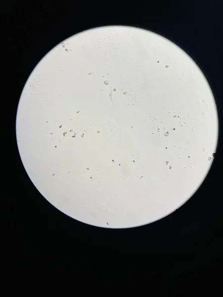 Microscopic View Struvite Crystals Urinary Sediment Magnesium Ammonium Phospate Crystals — Stock Photo, Image