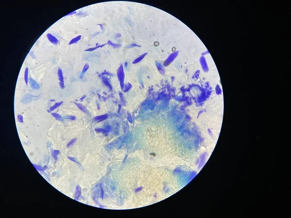 Ergebnisse Der Hautuntersuchung Mit Einfacher Färbung Unter Dem Mikroskop Entzündungszellen — Stockfoto