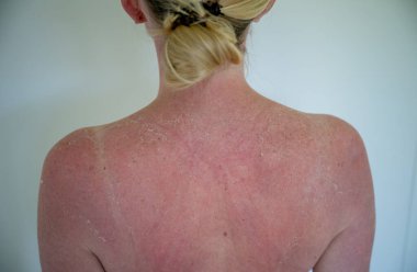 Güneşe maruz kaldıktan sonra derisi soyulmuş bir kadının sırtı güneşte yanmış..