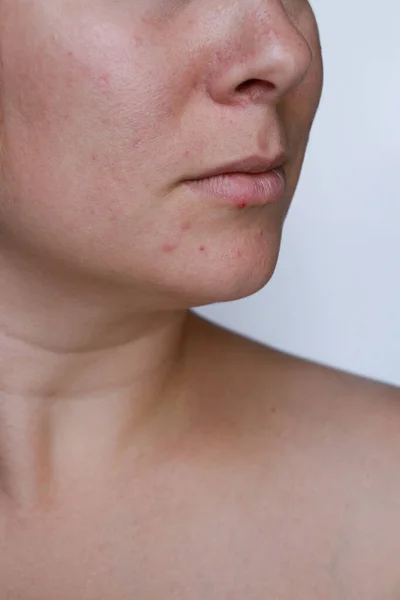 Fechar Pele Natural Mulher Acne Ruim Com Cicatrizes Foto Alta — Fotografia de Stock
