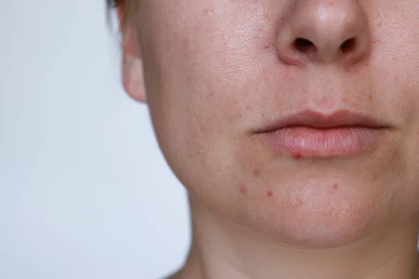 Närbild Naturlig Kvinna Dålig Akne Hud Med Ärr Högkvalitativt Foto — Stockfoto