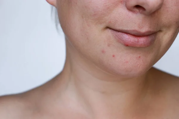 Närbild Naturlig Kvinna Dålig Akne Hud Med Ärr Högkvalitativt Foto — Stockfoto