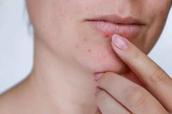 Close Natural Woman Bad Acne Skin Scars High Quality Photo — Stock Photo, Image