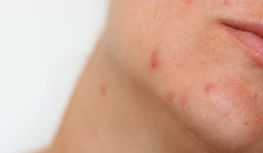 Kırmızı sorunlu sivilceli, yara izli, bulanık beyaz arka planlı bir kadın yüzü. 