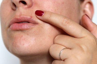 Kırmızı sorunlu sivilceli, yara izli, bulanık beyaz arka planlı bir kadın yüzü. 