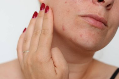 Kırmızı sorunlu sivilceli, yara izli, bulanık beyaz arka planlı bir kadın yüzü. 