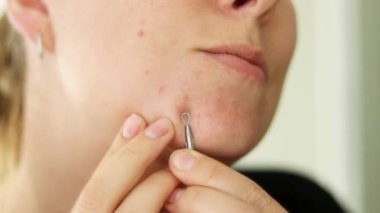 Dişi sivilce derisini kapatın. Çenesinden bir aletle sivilcelerini sıkan bir kadın. Evde sivilce tedavisi. Yüksek kaliteli FullHD görüntüler