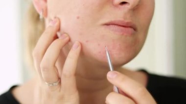 Dişi sivilce derisini kapatın. Çenesinden bir aletle sivilcelerini sıkan bir kadın. Evde sivilce tedavisi. Yüksek kaliteli FullHD görüntüler