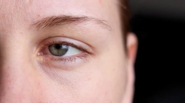 Kafkasyalı bir kadının yüzüne yakın, tek gözü kızarık, enfeksiyon konjonktiviti var. Yüksek kaliteli FullHD görüntüler