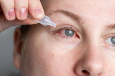 Evinde göz bebekleri iltihaplı kırmızı göze göz damlası süren bir kadının yakın çekimi. Sağlık hizmeti kavramı