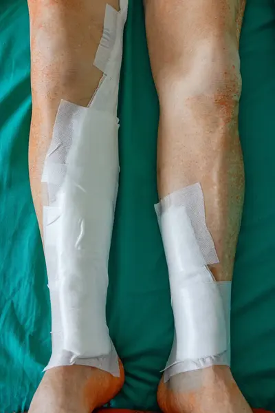 Bandages on a man's legs after vein surgery. Close-up of the patient's legs. Rehabilitation and senior health care concept