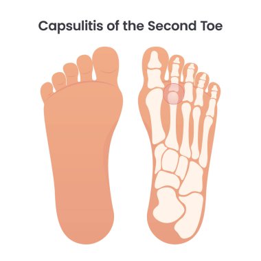 Capsulitis of the Second Toe medical vector illustration graphic clipart