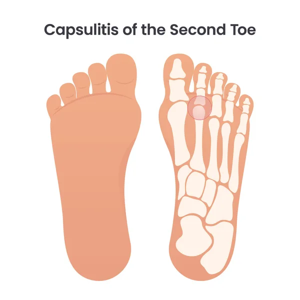 İkinci parmak tıbbi vektör illüstrasyonunun kapsülü