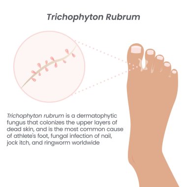 Trichophyton rubrum athlete's foot fungal infection clipart