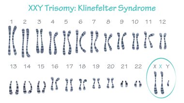 Klinefelter Syndrome XXY trisomy karyotype graphic