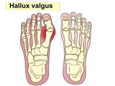 Hallux valgus. Anatomi. İnsan ayağı bon anatomisi. İnsan ayak kemikleri. Ayağı oluşturan ana kısımlar gösteriliyor. Temel tıp eğitimi için. İmza ve metin. Klinik setleri için de