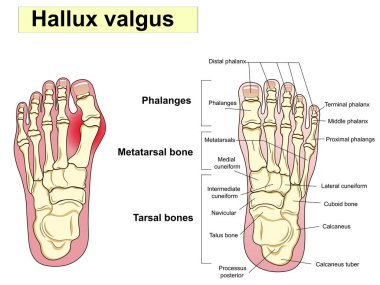 Hallux valgus mesajı. Anatomi. İnsan ayağı bon anatomisi. İnsan ayak kemikleri. Ayağı oluşturan ana kısımlar gösteriliyor. Temel tıp eğitimi için. İmza ve metin. Klinik setleri için de