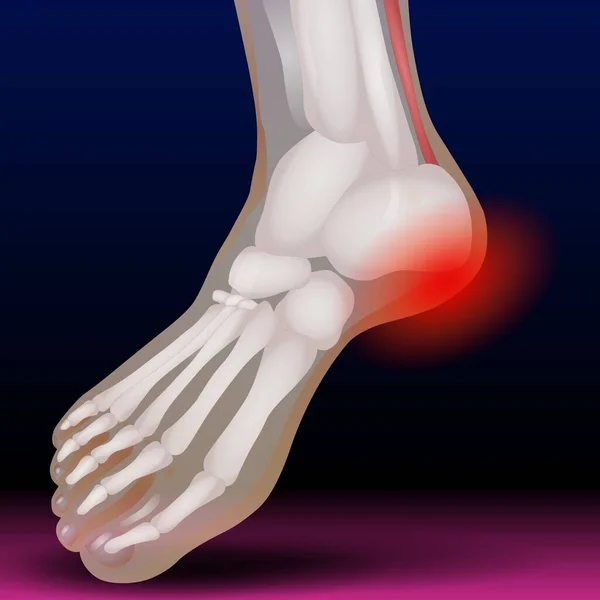 Toe Bone - Fla source file available - Fractures of the toes and forefoot are quite common. Fractures can result from a direct blow to the foot  such as accidentally kicking something hard or dropping a heavy object on your toes.