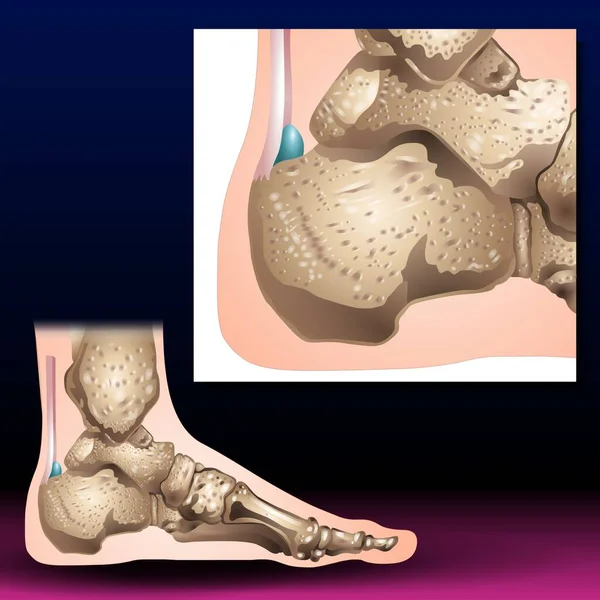 Toe Bone - Fla source file available - Fractures of the toes and forefoot are quite common. Fractures can result from a direct blow to the foot  such as accidentally kicking something hard or dropping a heavy object on your toes.