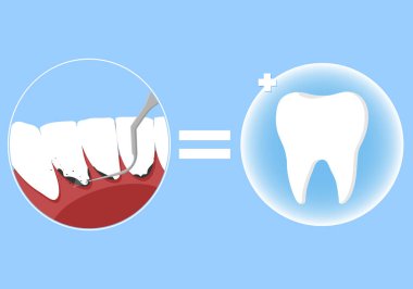 Profesyonel diş temizleme vektörü çizimi. Diş temizliği için randevu al.