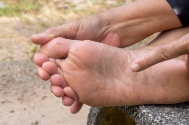 Woman hand is pointing at foot sore caused by Athlete's foot. Patient is suffering from severe foot skin disease. Close up photo of foot disease 