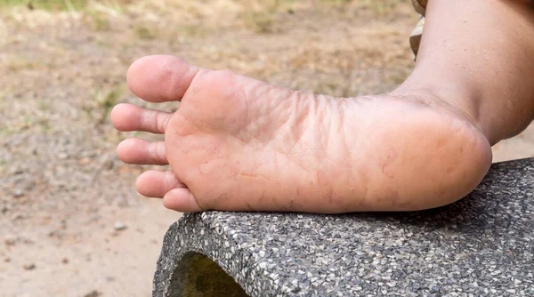 Woman is suffering from foot sore caused by Athlete\'s foot. Patient is suffering from severe foot skin disease. Close up photo of foot disease, Concept of unhealthy human foot