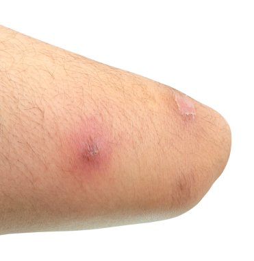 Apse veya insan uyluğundaki deri hastalığı png dosya biçiminde kırpma yolu ile izole edilir.