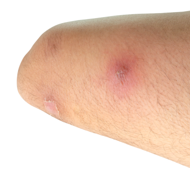 Apse veya insan uyluğundaki deri hastalığı png dosya biçiminde kırpma yolu ile izole edilir.