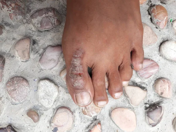 Psoriasis eczema dermatitis on the big toe which makes the sufferer's skin red, scaly, and itchy