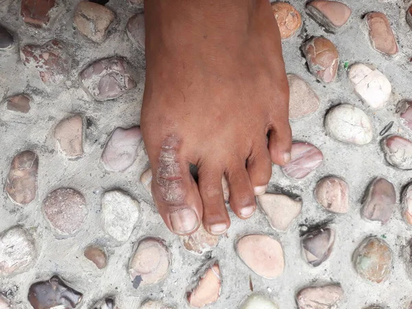 Psoriasis eczema dermatitis on the big toe which makes the sufferer's skin red, scaly, and itchy