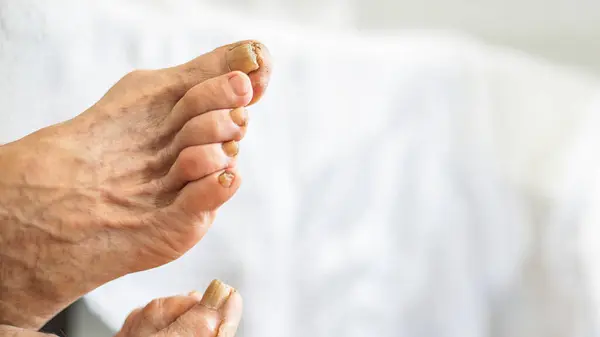 Yetişkin ayaklarının çeşitli sorunları, nasırları, kuru derisi, nasırları, nasırları ve varisleri olan tırnaklarını kapat..
