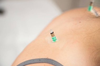Beyaz kadın, geleneksel Çin tıbbının terapi tekniğini uyguluyor. Vücudun belli kısımlarında ısı kullanılıyor. Moxibustion. Ağrı kesici tedavisi.
