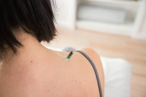 Beyaz kadın, geleneksel Çin tıbbının terapi tekniğini uyguluyor. Vücudun belli kısımlarında ısı kullanılıyor. Moxibustion. Ağrı kesici tedavisi.