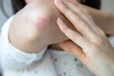 Close-up of a person touching a red, dry patch of skin on their elbow, showing signs of psoriasis or eczema, highlighting a skin condition that requires treatment or care. clipart