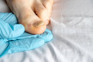  Kapalı alanda eldivenli eller tarafından incelenen hasarlı bir ayak tırnağının yakın çekimi. Tıbbi bakım, hijyen ve olası bir mantar enfeksiyonu, travma veya sağlık durumuna dikkat çekiyor.