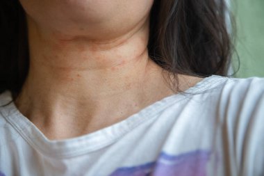 Kadının boynundaki yakın plan görüntülerde kızarıklık ve tahrişe bağlı alerjik deri reaksiyonu görülüyor. Egzama ya da atopik deri iltihabı olabilir. Dermatolojik referans için kapalı alanda yakalanmış.