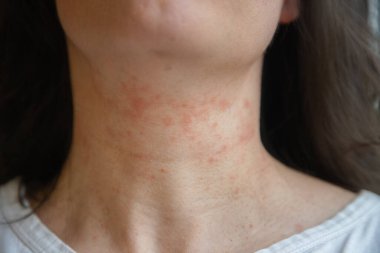 Kadının boynundaki yakın plan görüntülerde kızarıklık ve tahrişe bağlı alerjik deri reaksiyonu görülüyor. Egzama ya da atopik deri iltihabı olabilir. Dermatolojik referans için kapalı alanda yakalanmış.
