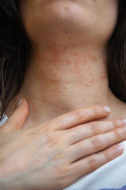 Kadının boynundaki yakın plan görüntülerde kızarıklık ve tahrişe bağlı alerjik deri reaksiyonu görülüyor. Egzama ya da atopik deri iltihabı olabilir. Dermatolojik referans için kapalı alanda yakalanmış.